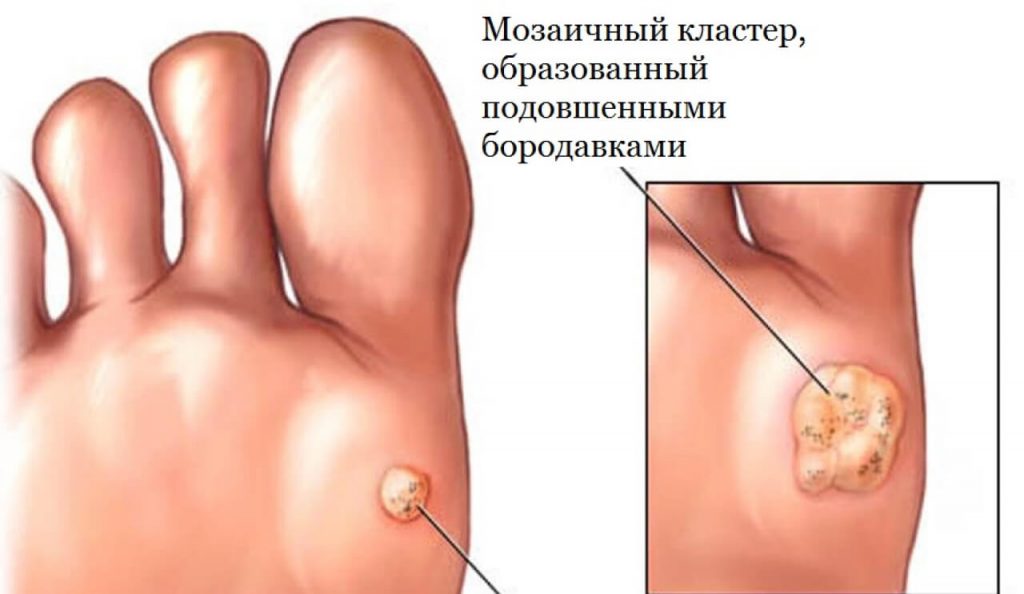 Лечение бородавок в Вишневом